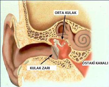 Ani gelişen orta kulak iltihabı (Akut Otitis Media) nedir? - Op. Dr. İbrahim Erdim
